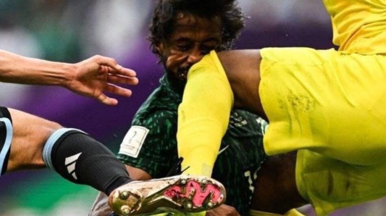 Появился жуткий снимок защитника саудовцев с выбитыми зубами. Это фейк?