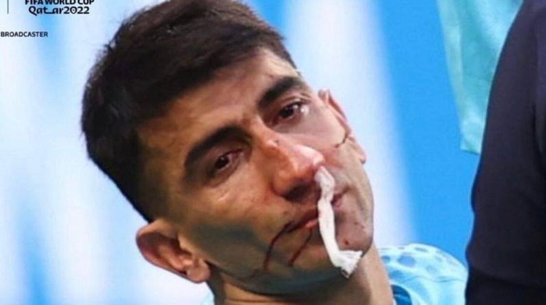 Голкипер сборной Ирана больше не сыграет на ЧМ. В матче с Англией он получил травму головы